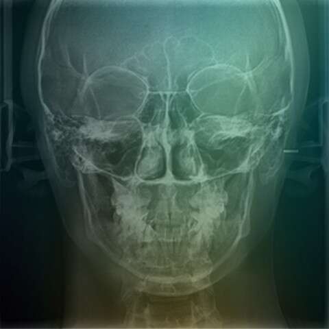 radiografia-senos-paranasales