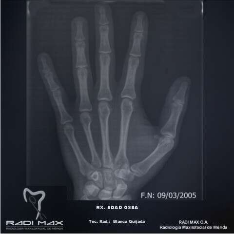 radiografia-edad-osea