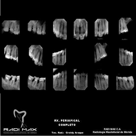 radiografia-periapical