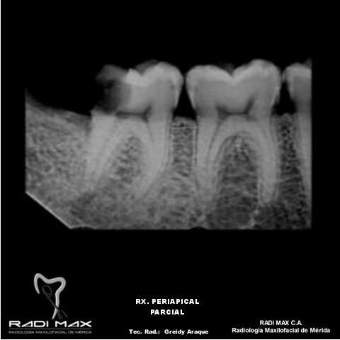 radiografia-periapical-parcial