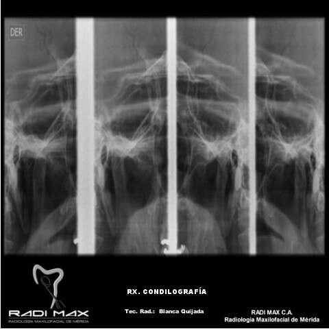 radiografia-condilografia