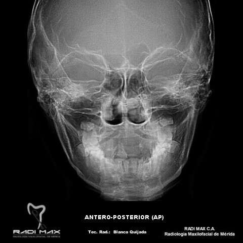 radiografia-antero-posterior