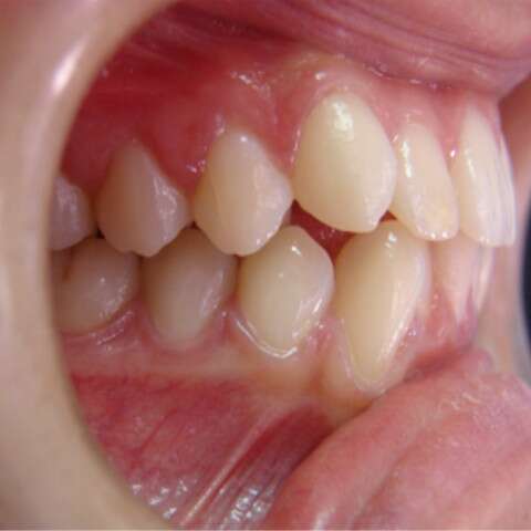 fotografia-oclusal-derecho