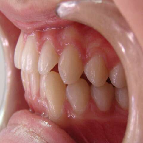 fotografia-oclusal-izquierdo