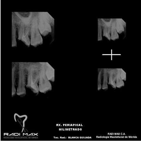 radiografia-periapical-milimetrado